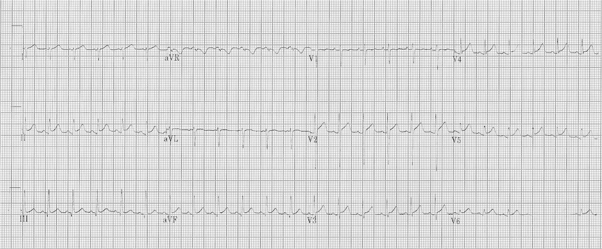 ECG myocarditis 2