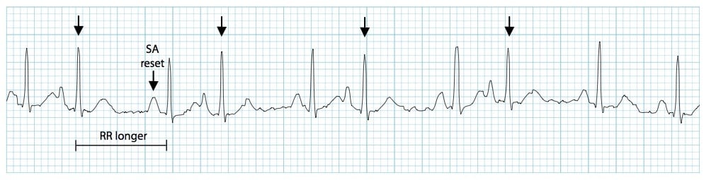 Premature Atrial Complex (PAC) 1