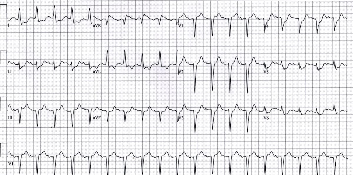 ECG LMCA Occlusion 2 Left main coronary artery (LMCA)