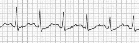 Hidden P waves in sinus tachycardia