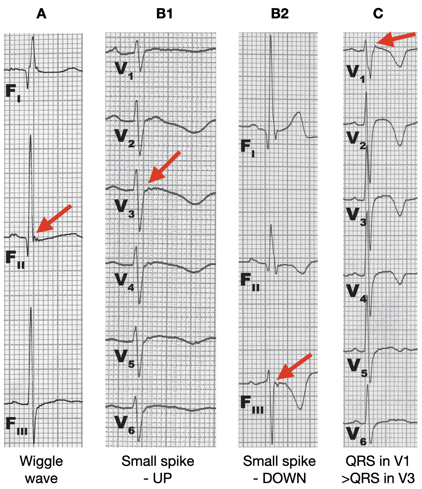 Patterns of epsilon waves wang et al 2010 2
