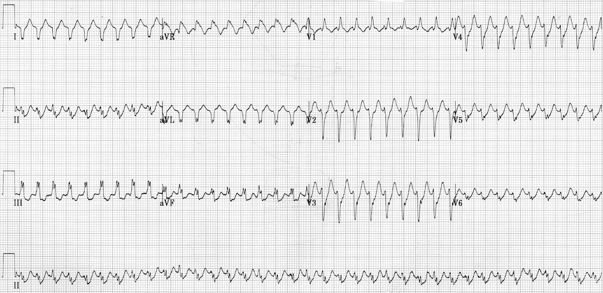 ECG Primary idiopathic fascicular VT 3a