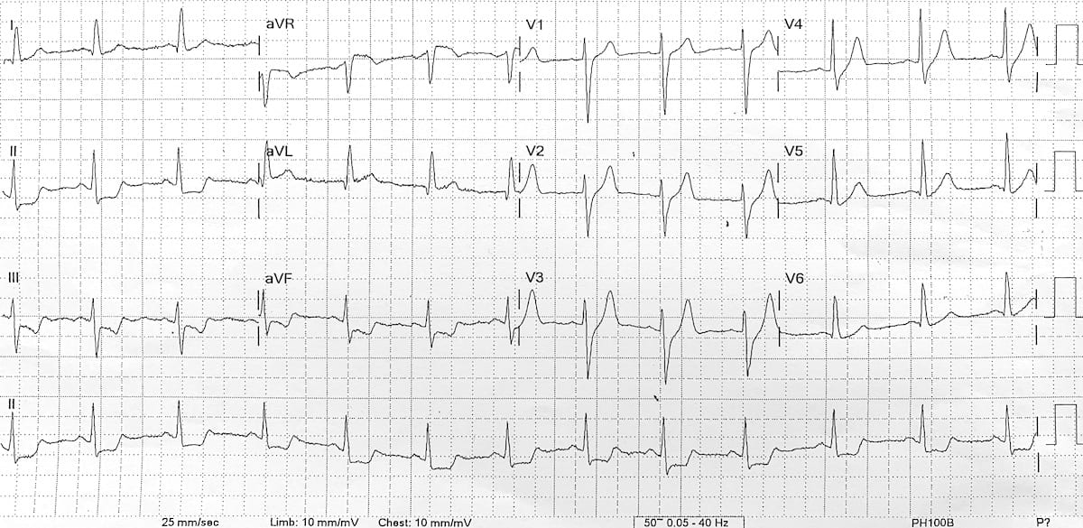 De Winter T waves ECG pre-arrest