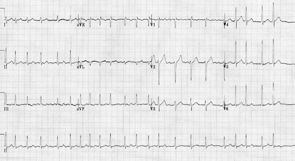 ECG Atrial Fibrillation 4