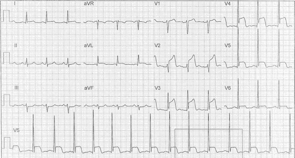 ECG Case 116b LITFL Top 100 EKG
