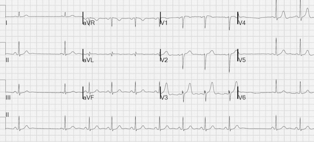 ECG Type II sino-atrial exit block