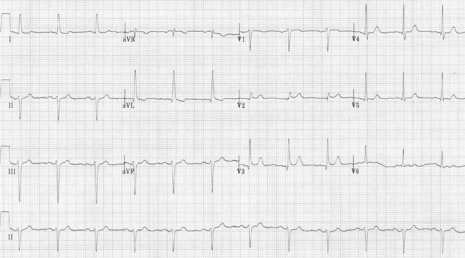 ECG 3 Left Anterior Fascicular Block (LAFB)