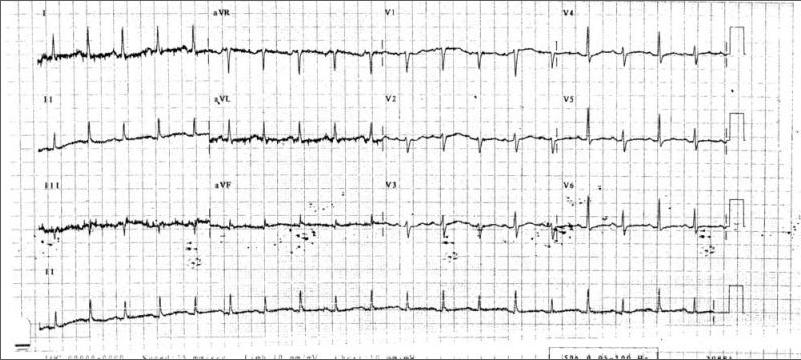 Paradoxical Alternative ECG