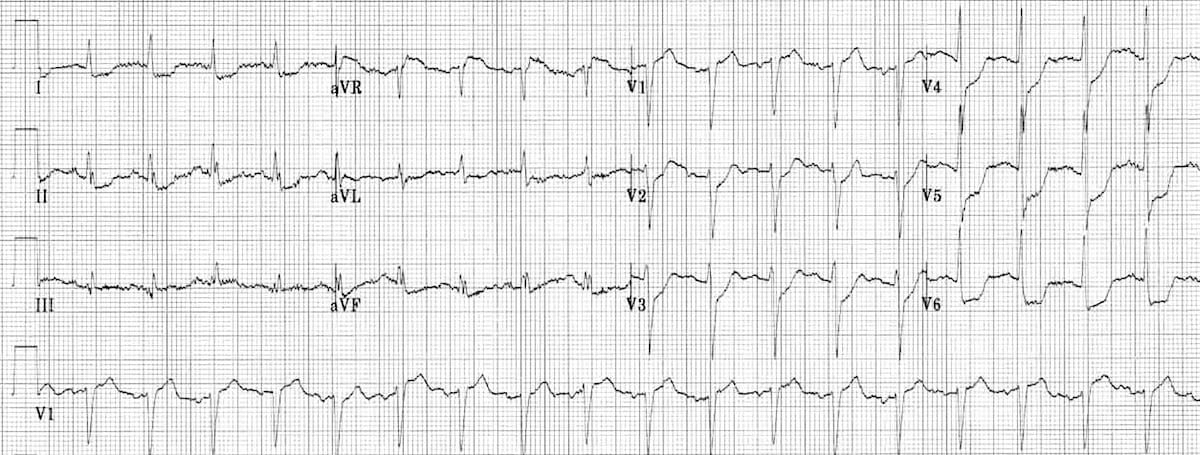 ECG LMCA 9