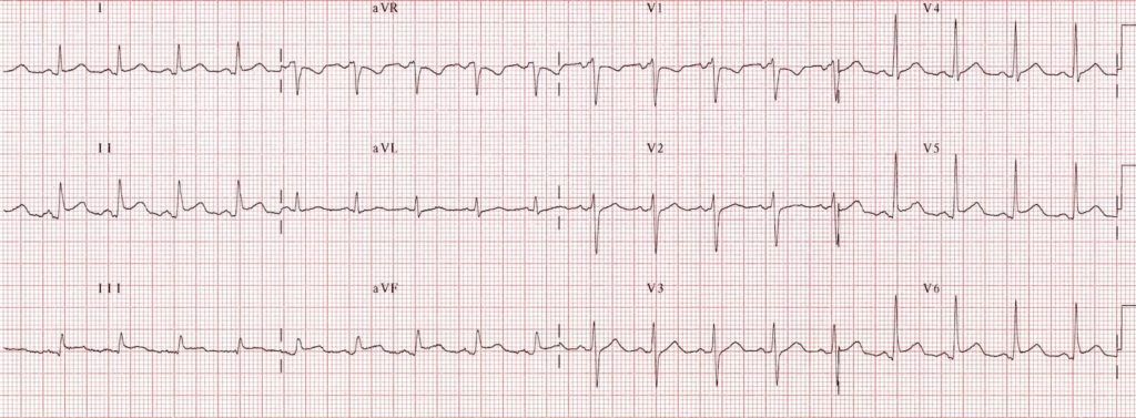 TOP 100 ECG QUIZ LITFL 032