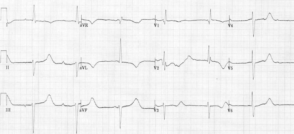 ECG Hypothermia long QT shivering artifact