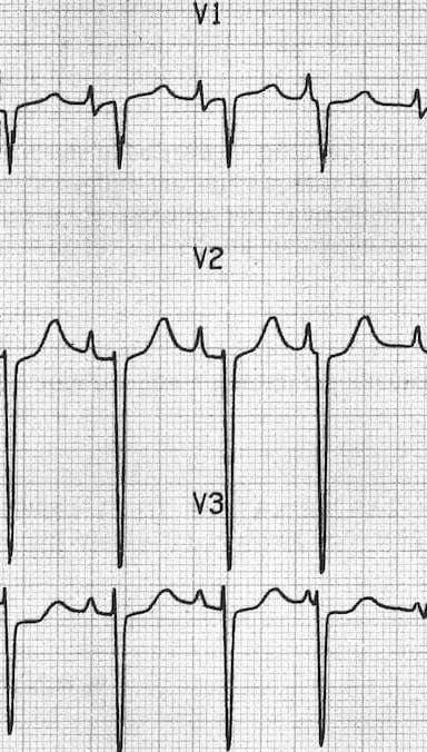 P pulmonale Right atrial hypertrophy in V1 V2