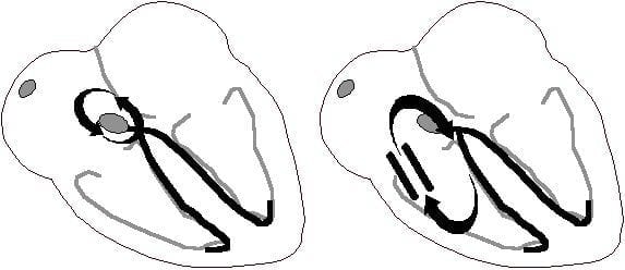 re-entry-tachycardias