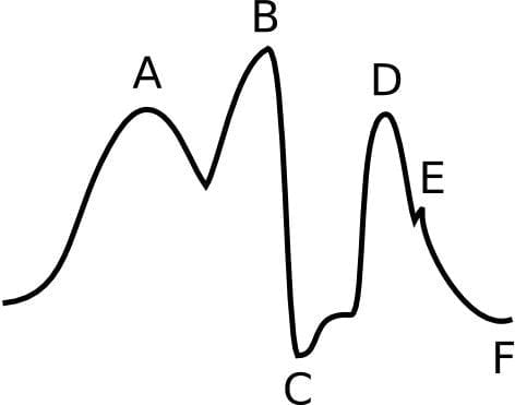 IABP waveform