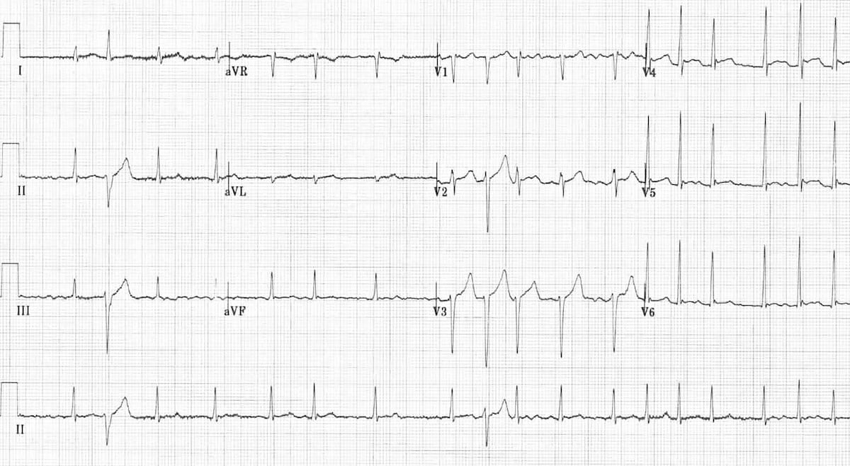 ECG Ashman aberrancy 4