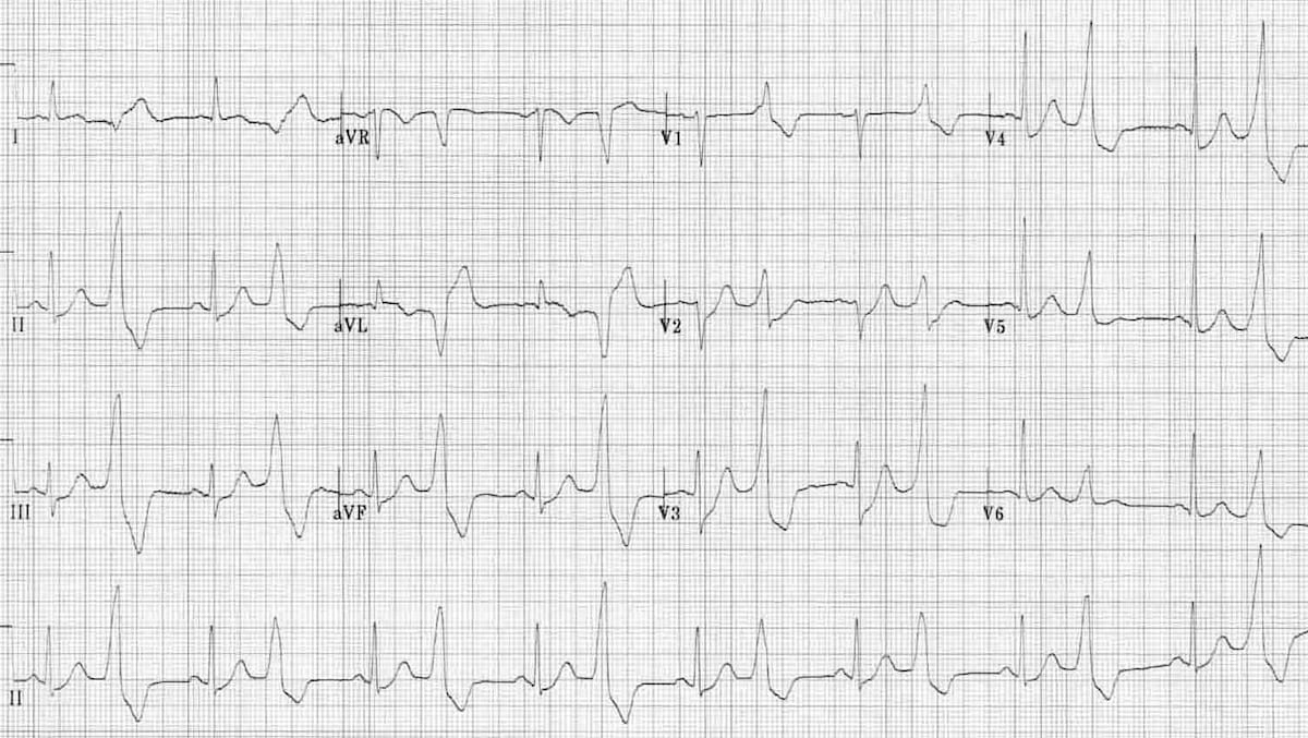 ECG Premature Ventricular Complex (PVC) Bigeminy