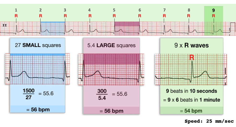 ECG RATE rhythm strip 10 seconds 300 1500 rules ECG