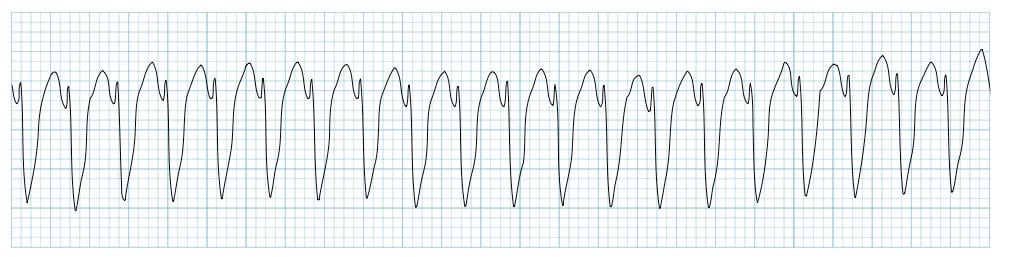 Monomorphic ventricular tachycardia VT