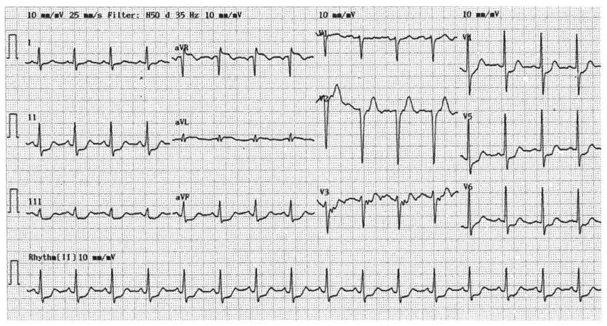 OMI ECG The Forgotten Lead aVR in Left Main Disease. Am J Med. 2015
