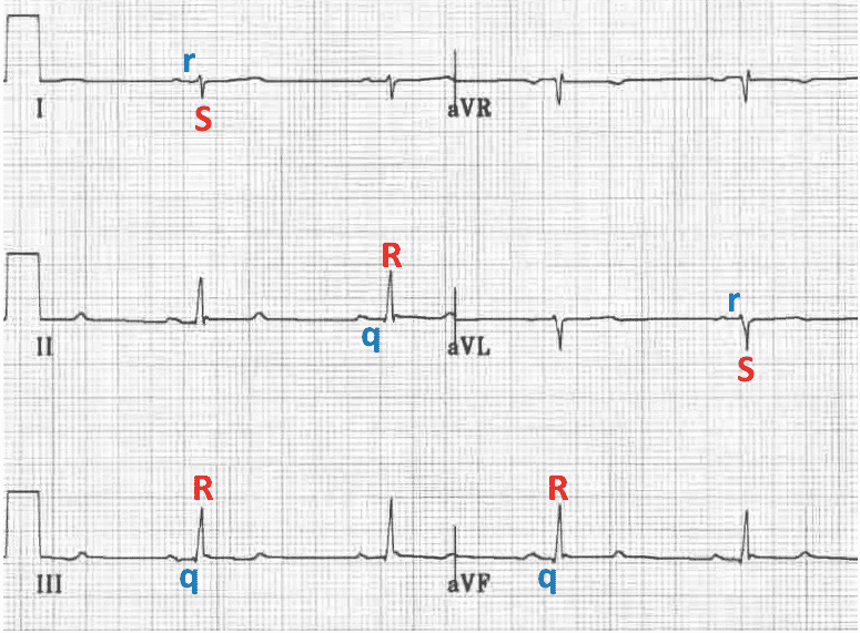 Left Posterior Fascicular Block (LPFB) lqR rS complexesLeft Posterior Fascicular Block (LPFB) qR rS complexes
