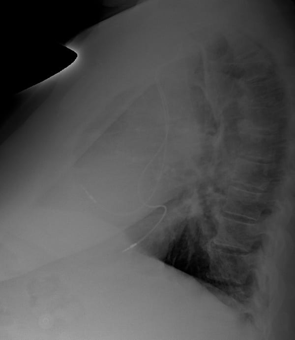 ECG Case 111 Lat CXR Post PPM