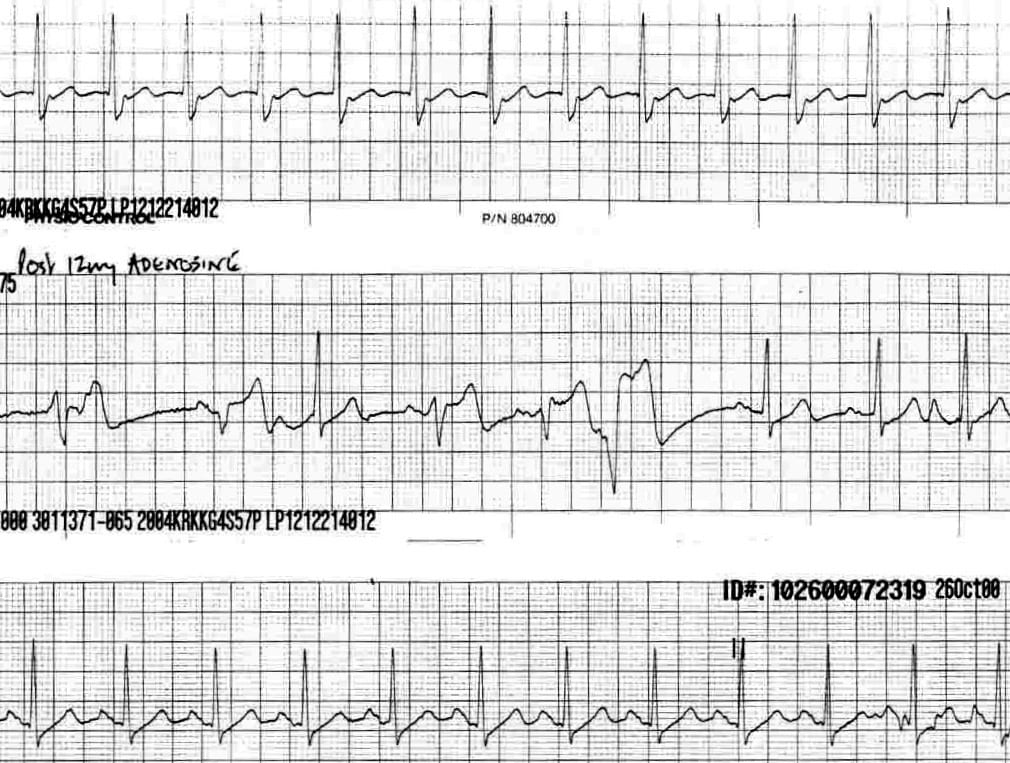 TOP 100 ECG QUIZ LITFL 017