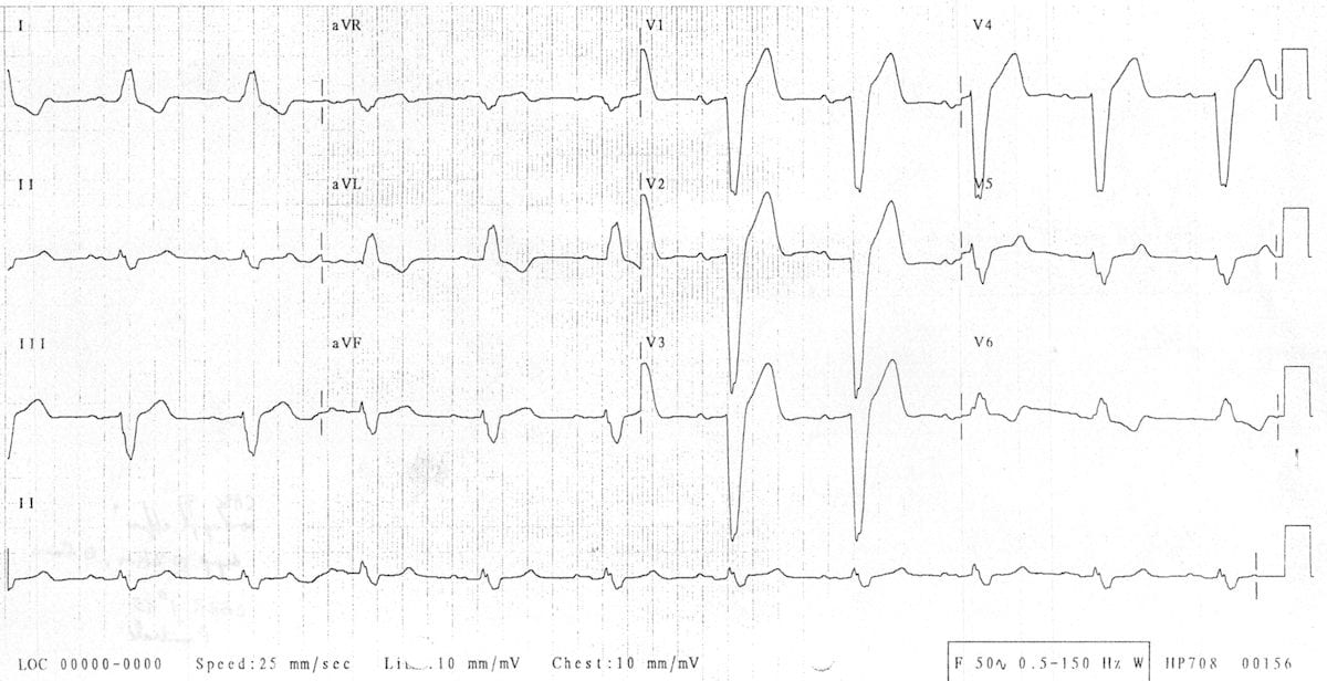 Left bundle branch block LBBB 4