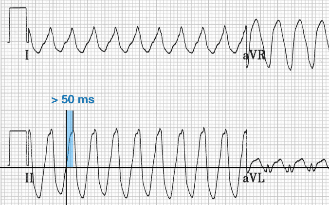 R-Wave Peak Time (RWPT) Lead II
