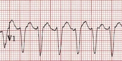 LBBB-like-morphology