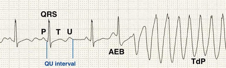ECG Hypokalemia Long QU interval Torsades