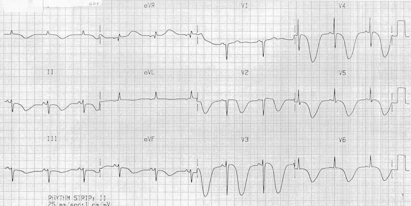ECG TWI Raised intracranial pressure (ICP) SAH