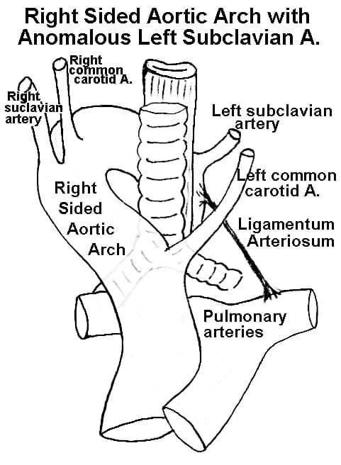 right sided aortic arch