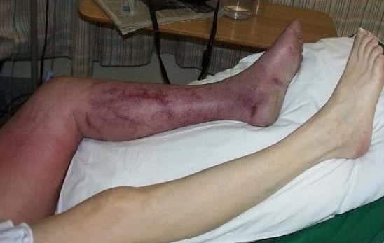 Phlegmasia coerulea dolens