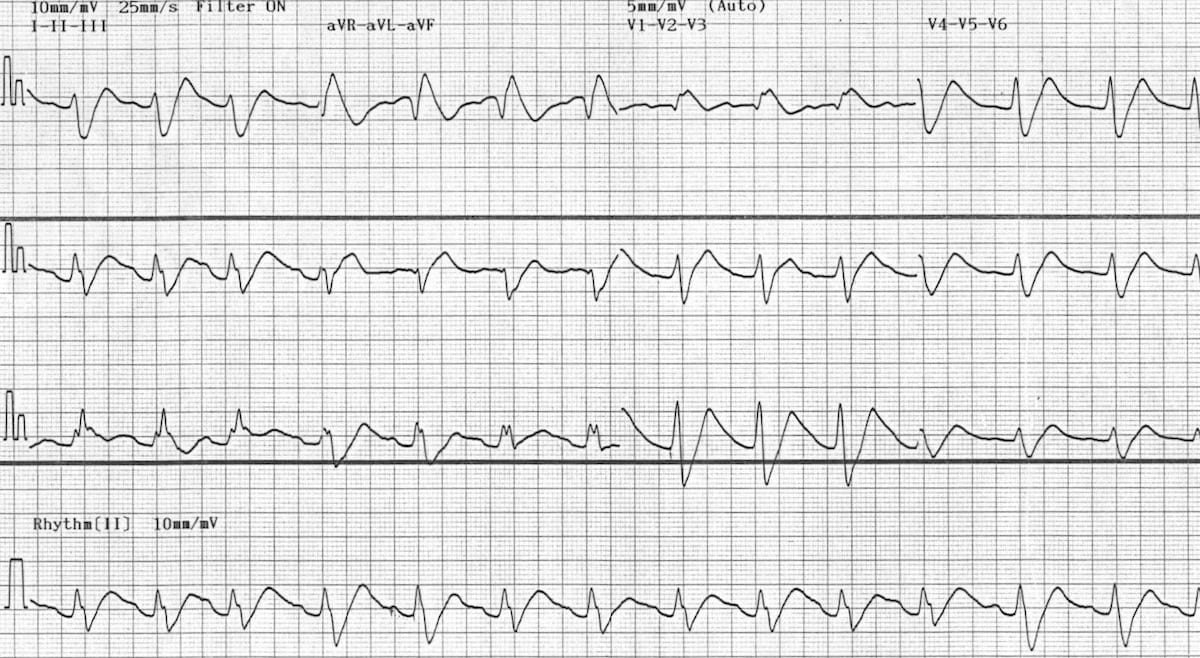 ECG Flecainide toxicity 3