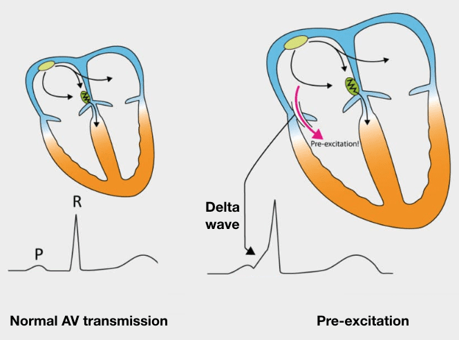 WPW Delta wave pre=excitation