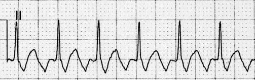ECG Flutter waves in II.