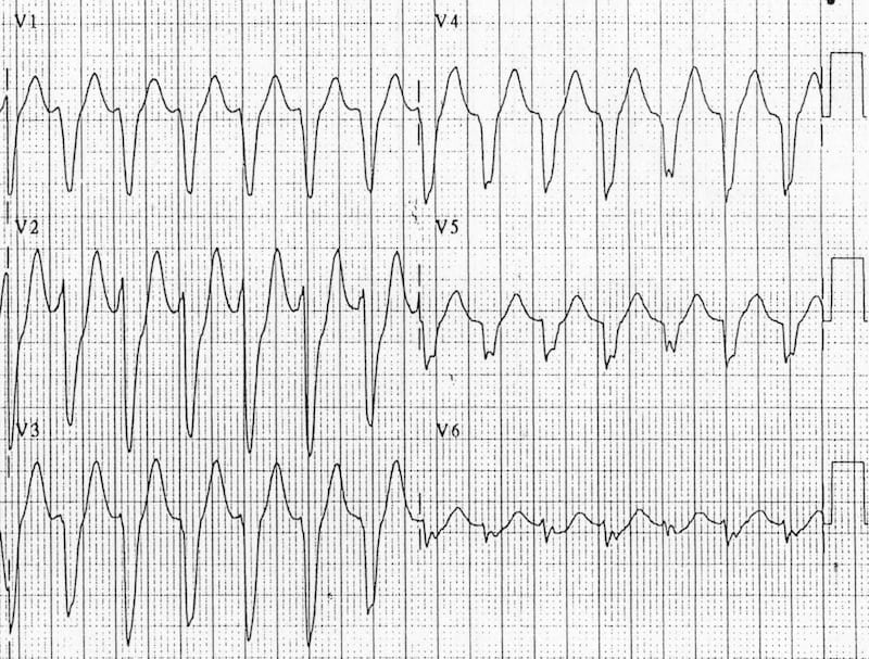 ECG VT Negative precordial concordance 2