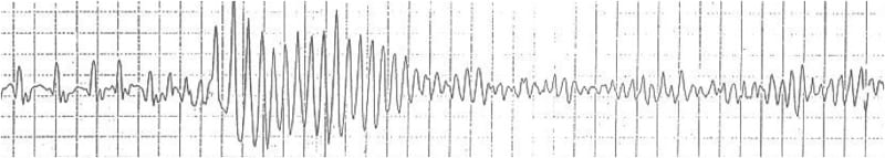 ECG Rhythm strip Exigency 003 3