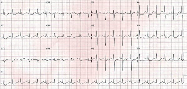 ECG LMCA