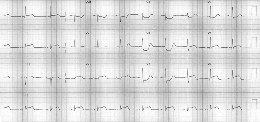 TOP 100 ECG QUIZ LITFL 014
