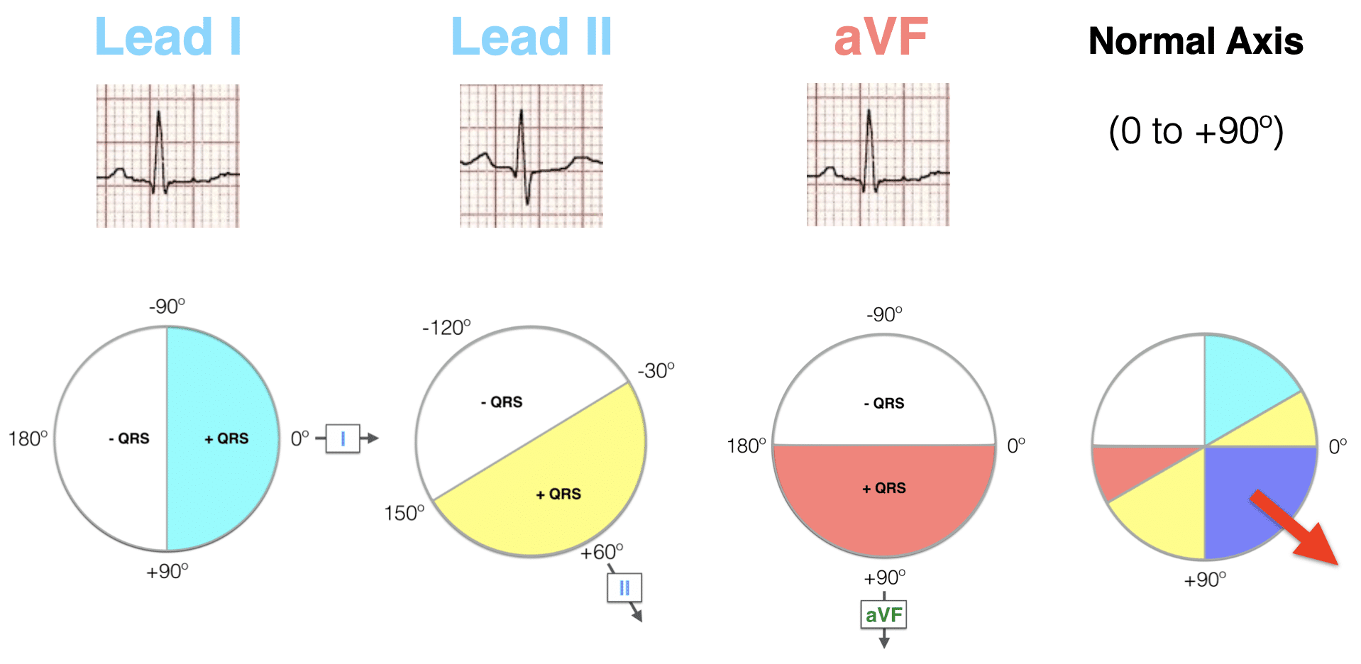 Lead I II aVF Hexaxial evaluation Normal axis 2021