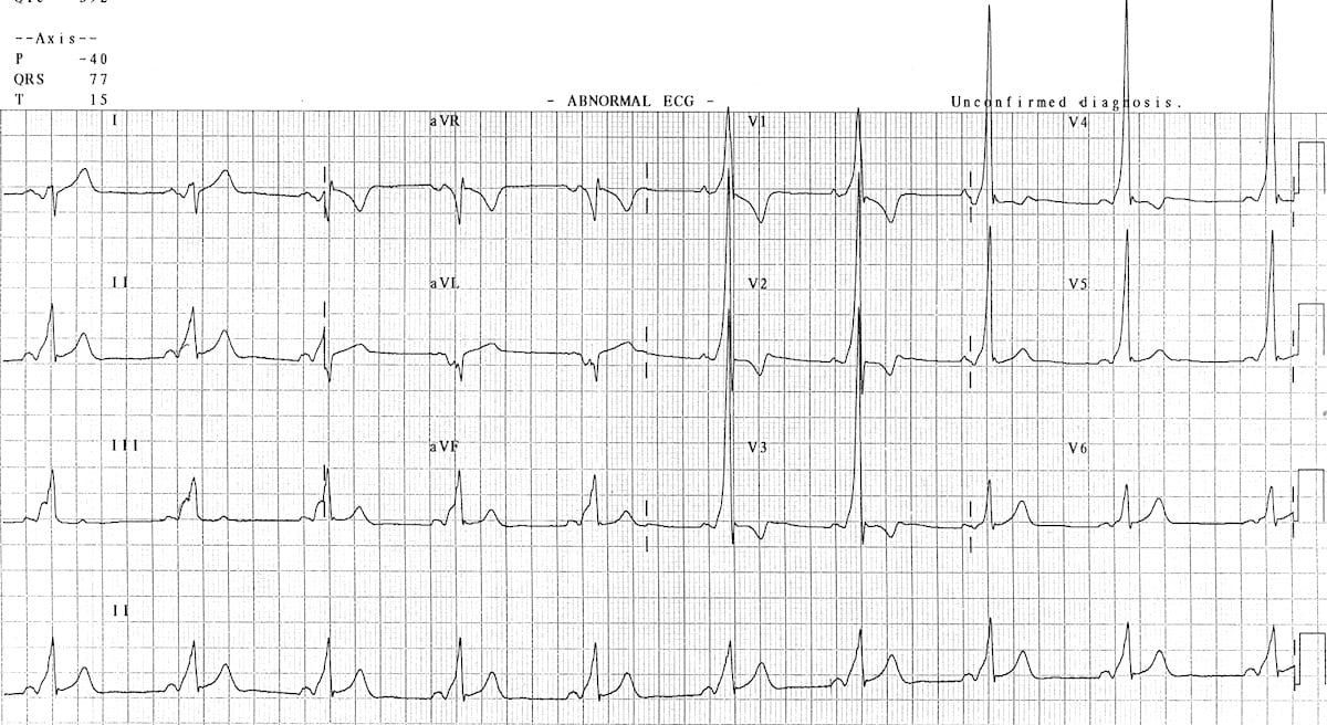Type A WPW ECG 3