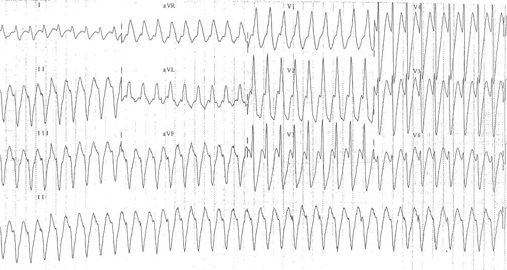 Monomorphic ventricular tachycardia VT 6