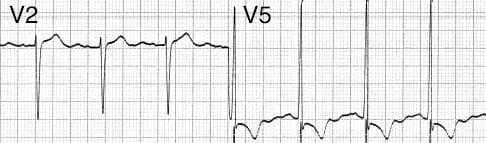 ECG LVH V2 and V5
