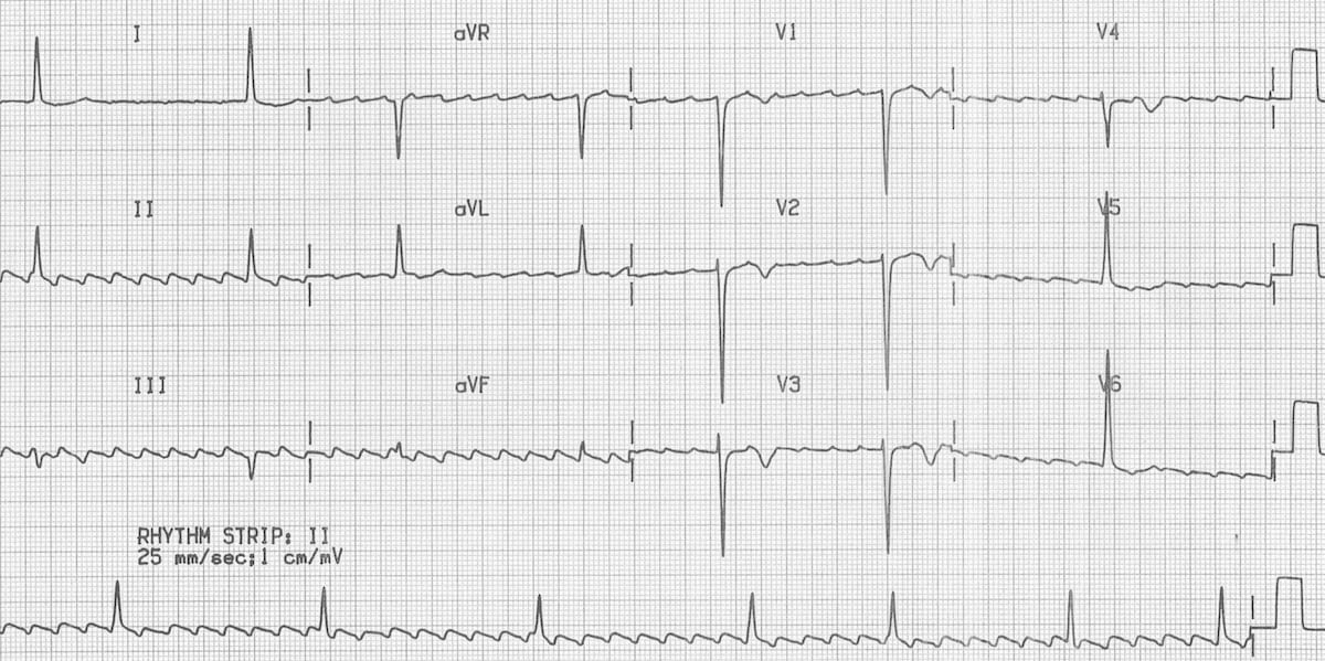 ECG Atrial Flutter with High-Grade AV Block