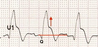 RBBB and STEMI
