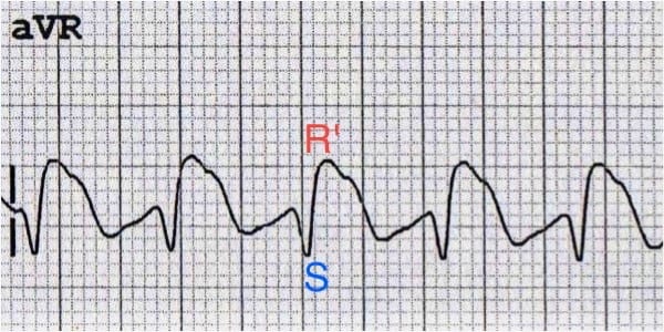 Dominant secondary R wave (R') in aVR