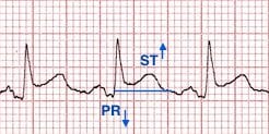 Pericarditis ST elevation and PR depression