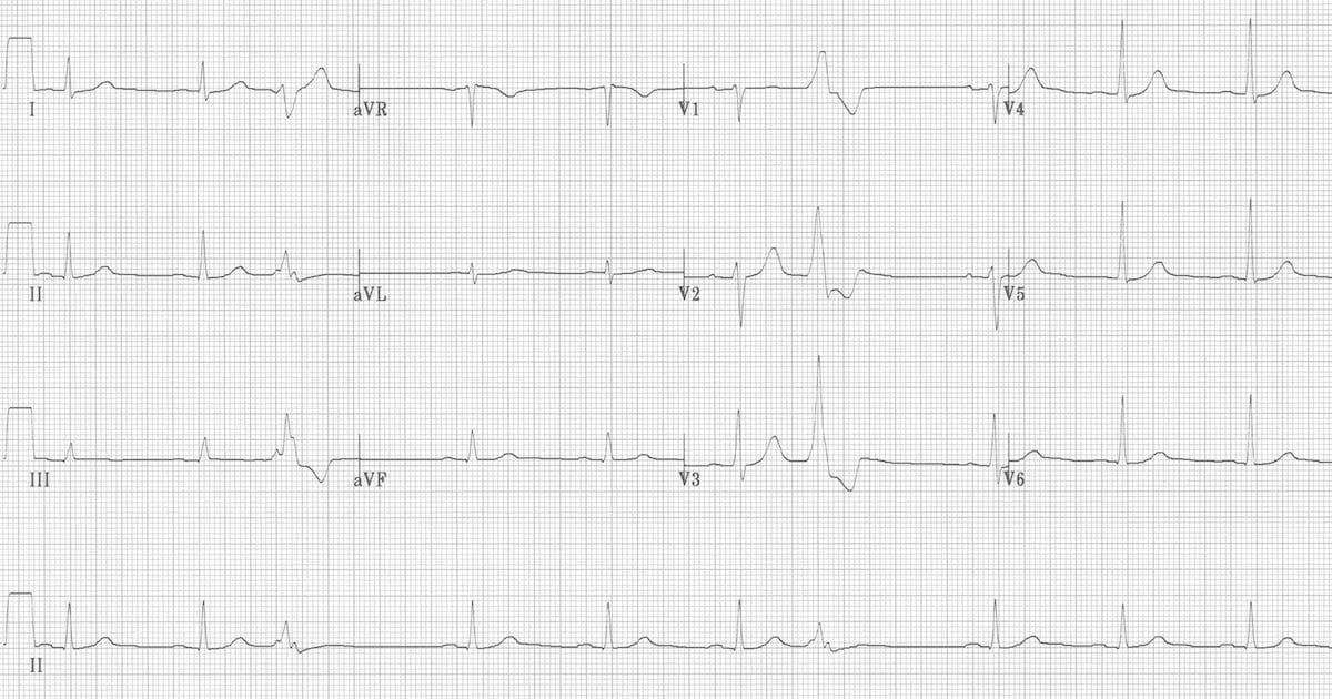 ECG Premature Ventricular Complex (PVC) Quadrigeminy