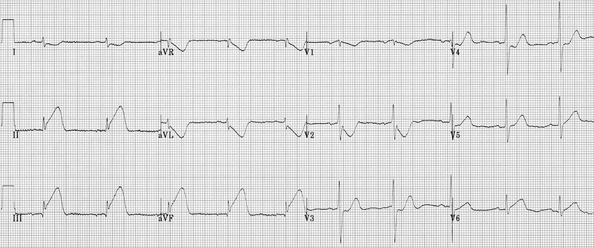 ECG Inferior AMI STEMI Hyperacute